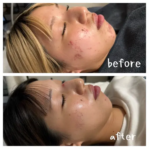 【荻窪駅30秒】人気No.1🌿針入りハーブピーリング✨毛穴/肌質改善