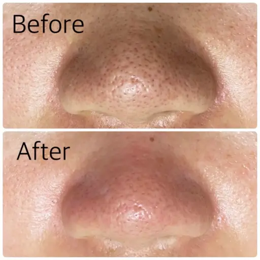 毛穴洗浄美肌コース