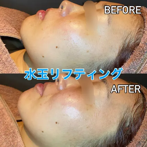 🇰🇷韓国で大人気🇰🇷水玉リフティング🫧赤ちゃんのようなふわふわお肌に👼