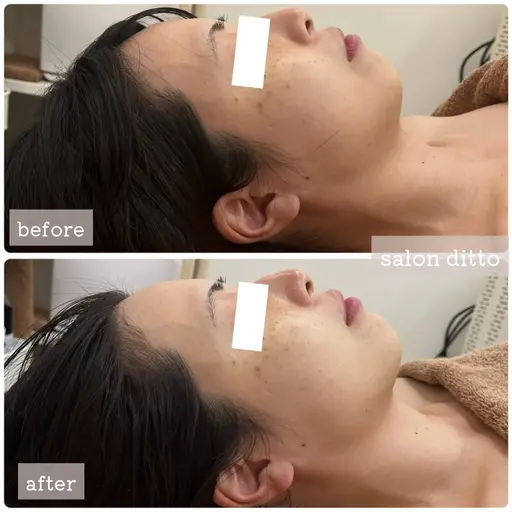 【4月🌸minimo限定】小顔コルギ＋炭酸ドライヘッドスパ (80分)