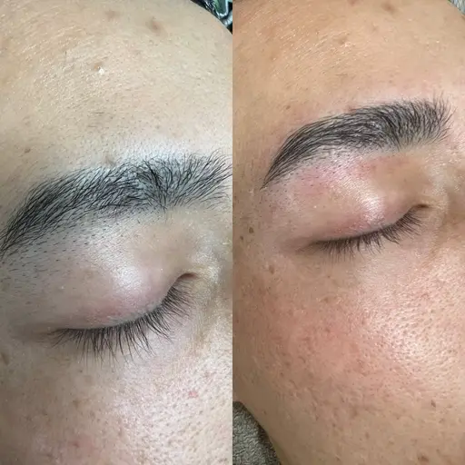 ヒゲ脱毛＋HBL（ハリウッドブロウリフト）