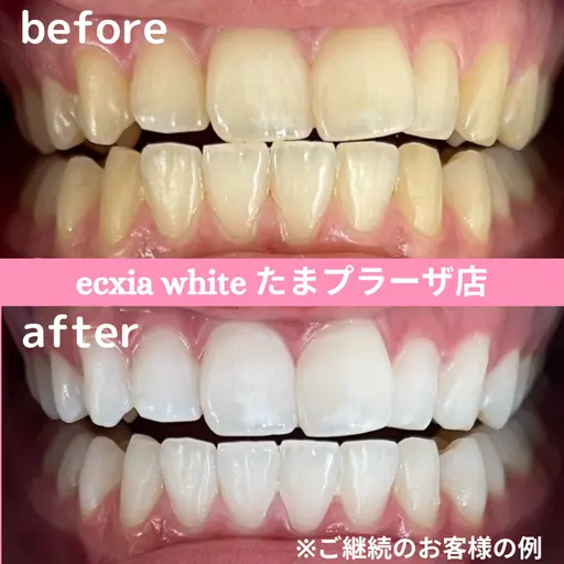 人気No.1!!平均5トーンUP⭐︎たっぷり60分プレミアム歯科ホワイトニング初回体験 ¥14800→¥11000