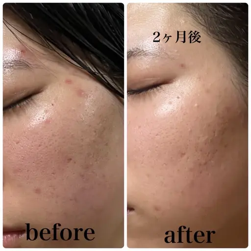 【Xで大バズり中🔥ポーラ肌分析】精密肌カメラを使ったお肌検査👀✨ 肌悩みや自分に合うケアを知りたい方の入口🚪