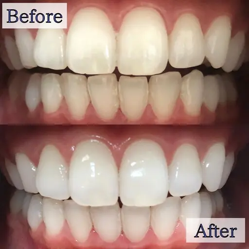 【1月限定🎍】8分照射×2回のセルフホワイトニング🦷スタートはここから🔰この冬は本気で白い歯へ