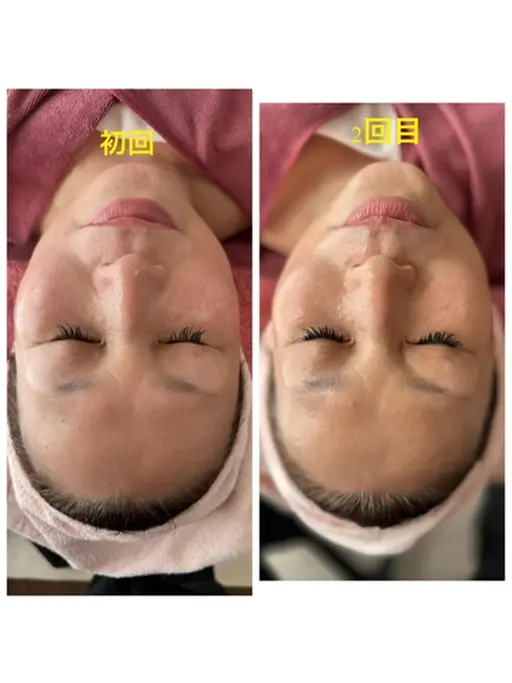 韓国で大ブーム☆　最新RedShot 脂肪にアプローチ　フェイスラインすっきり小顔へ！