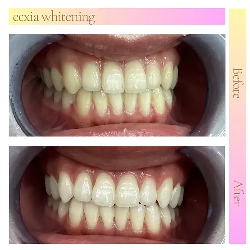 【minimo掲載記念✨️】セルフホワイトニング（9分×2回）¥390 別途料金なし