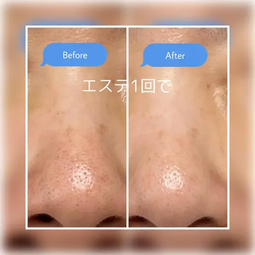 毛穴汚れスッキリコース