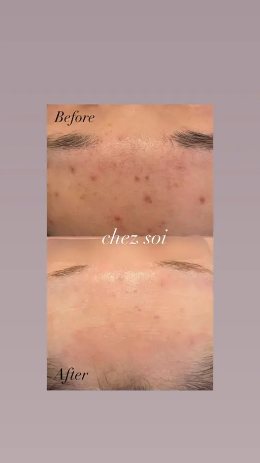 人気No.1🩶肌荒れ改善＋小顔　InstagramへBefore Afterの投稿可の方（目元の配慮させていただきます