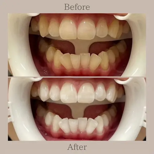 【再来】超音波セルフホワイトニング20分照射 ×1回🦷✨　¥7,000→¥6,300