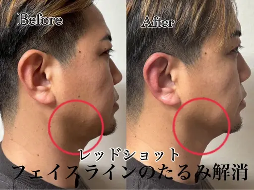 最新美容🌟導入価格【レッド💉🩸ショット】1回2cc導入で二重アゴ解消🌼すぐ実感できる韓国発🇰🇷輪郭形成💕