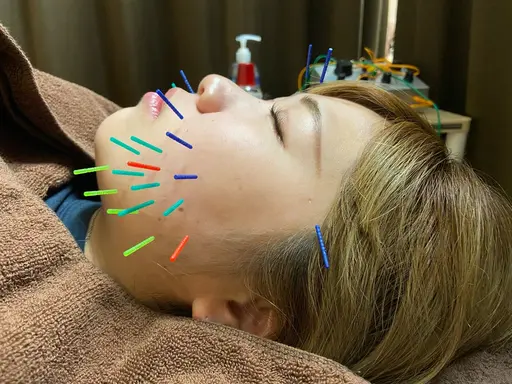 【美容鍼🪡✨️】