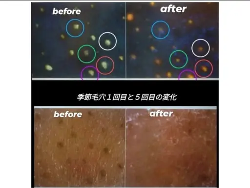 毛穴引き締めトライアルコース！！