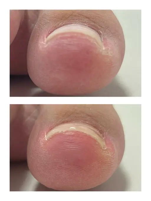 ［フット］巻き爪ケア ✳︎メンズOK✳︎