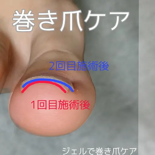 機能性特殊ジェルで巻き爪ケア👣韓国より上陸Hey Switch親指1本※要詳細確認