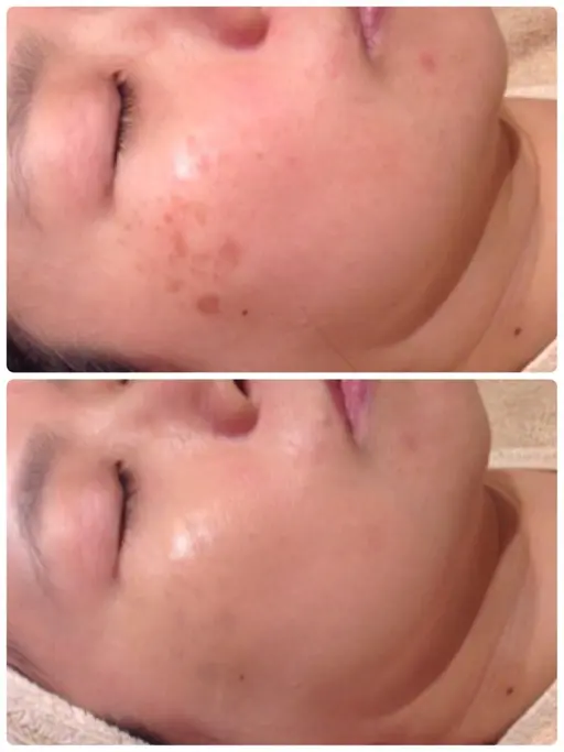 シミケア🖊️ご新規様限定