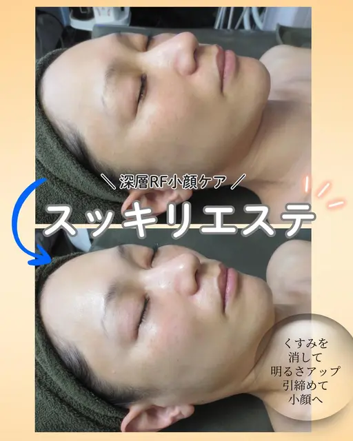 【期間限定】深層RF小顔ケア90分