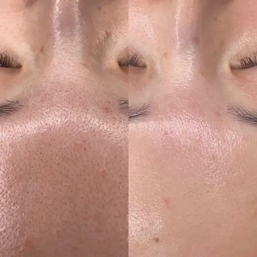 🇰🇷肌管理🫧アクアピール！毛穴洗浄で毛穴レス肌へ⭐︎クレンジング▶︎洗顔▶︎毛穴洗浄▶︎パック▶︎お仕上げ