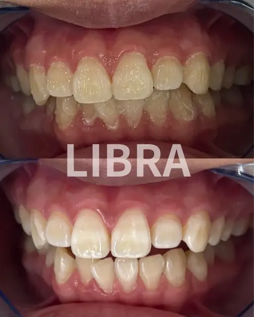 🔥当日限定🔥🔰ホワイトニング初めての方限定価格🔰【超🉐初回体験】しっかりカウンセリング👍合計20分照射!