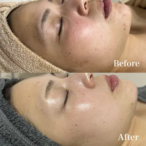 👑【12/31まで】究極美・ハーブピーリング37,200円 ▶︎ 19,800円✨️