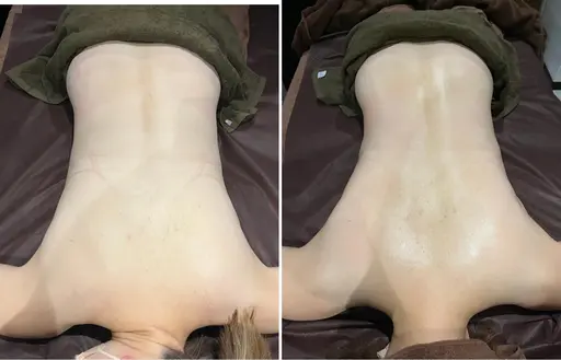 背中ニキビ・黒ずみを撲滅⚠️挙式やパーティーに向けて後ろ姿も美しく✨ハーブピーリング(背中上部)