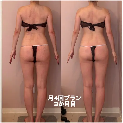 【姿勢美人 骨膜リリース】猫背・巻き肩・反り腰改善で“後ろ姿”が変わる!