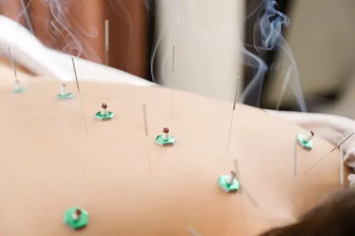 【長年の肩こりも改善‼️】肩こり整体＋選べる美容鍼でお終わった後は全身のむくみも取れてスッキリ実感‼️