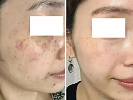 【1周年感謝祭　スペシャル企画】全顔シミ・毛穴ケア打ち放題✨