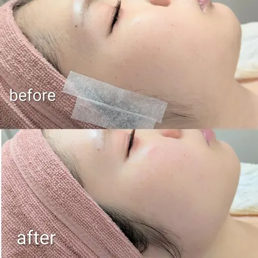 【つるん肌】フェイシャルWAX脱毛