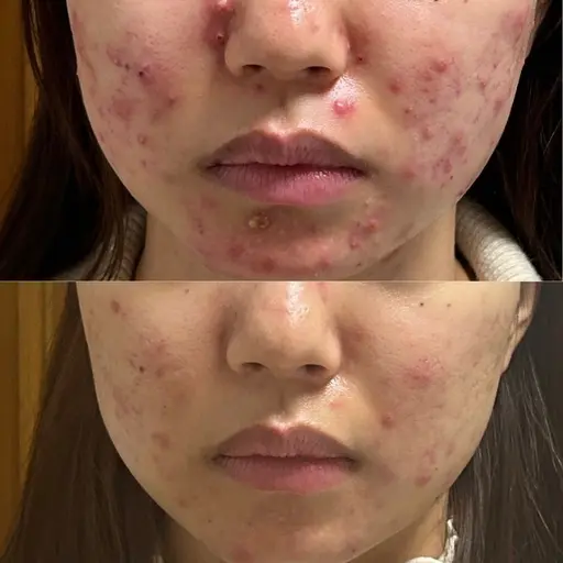 【フェイシャル】無添加ハーブ＆漢方ピーリング🌿敏感肌/脂性肌/ニキビ肌にも✨