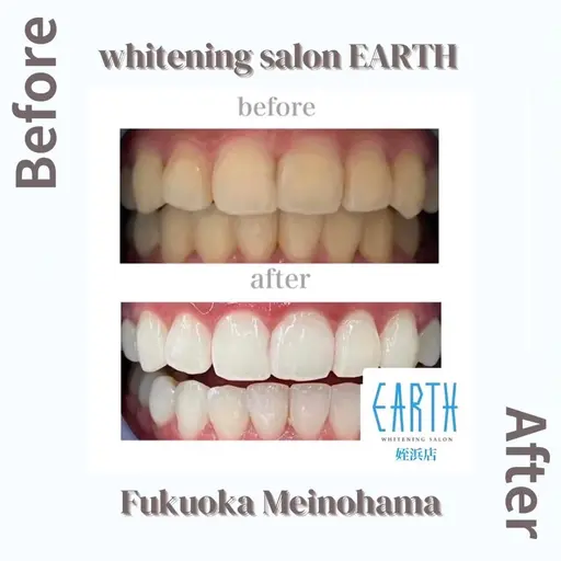 【お試しプラン】美白ホワイトニング10回コース　20分×10回　基本的には5日分