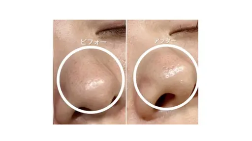 【お顔まるごと脱毛】フェイシャルワックス