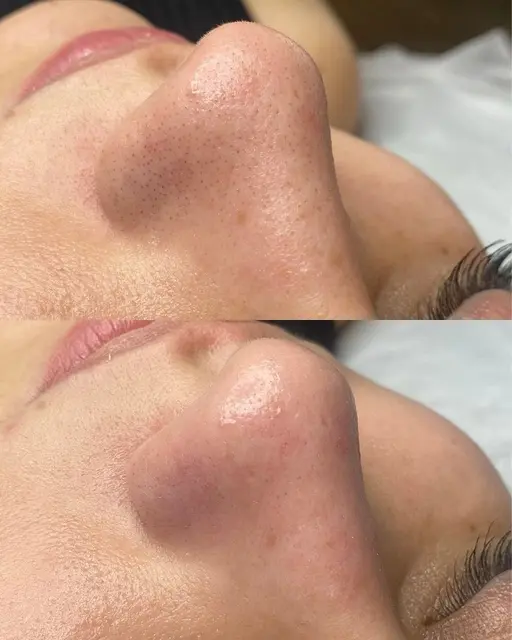 その鼻の黒ずみなんとかします！何をしてもどこにいっても綺麗にならないその鼻👃！角栓退治コース✨メンズもどうぞ🎵