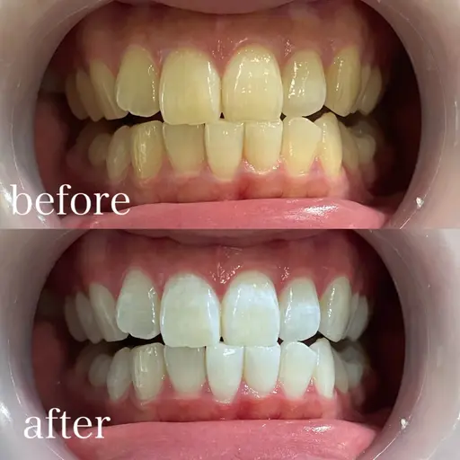 🦷✨黄ばみ終わらせる宣言✨🦷プレミアムホワイトニング【通常¥12100→初回¥4500❤️‍🔥】今すぐ予約限定❣️