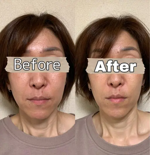 痩身マシン　2500shot