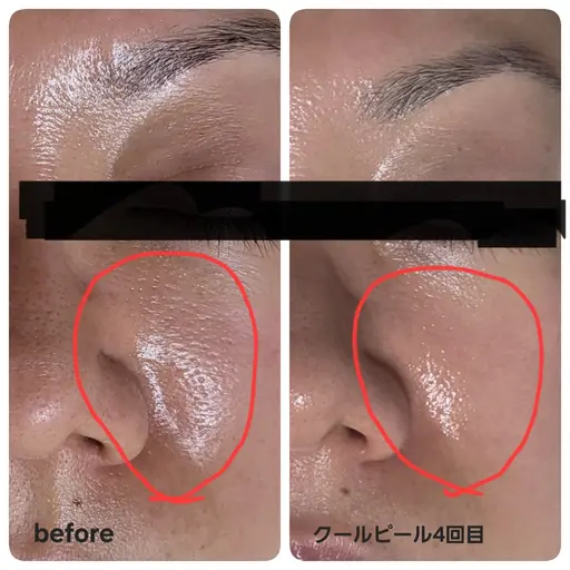 とにかく毛穴をなんとかしたい方へ‼️皮むけしないダウンタイム無し✨ピーリング&ビタミン導入で白く輝くハリ肌へ‼️