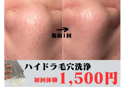 徹底的にお肌のお掃除を♪毛穴洗浄コース✨ピーリング剤使用で【毛穴詰まり/黒ずみ】スッキリツヤ肌！