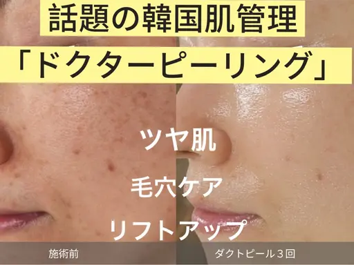 最先端ピーリング DactorPeel ➕ヘッドスパ60分