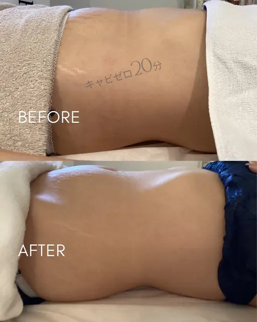 新！痩身メニュー「キャビゼロ」60分　部位は選択