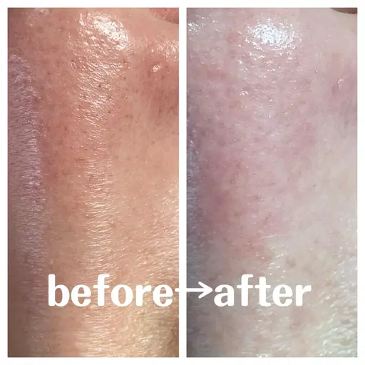 さよならイチゴ鼻。✨毛穴洗浄エステ✨✨