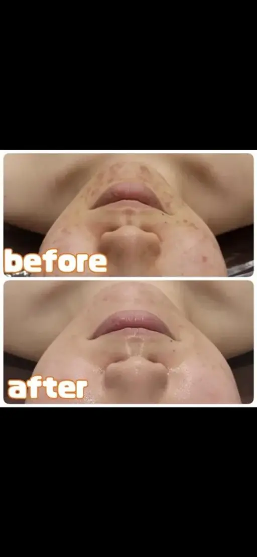 しつこいニキビの本気ケア🐮韓国白肌🐮🥛紫外線対策🐮話題の白玉スノーピーリング☆ニキビ/毛穴/乾燥/肌質改善/美白