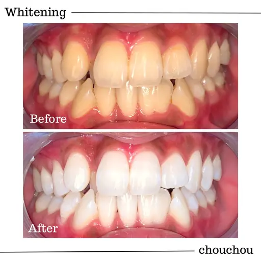【初回限定】高濃度医療ジェルホワイトニング