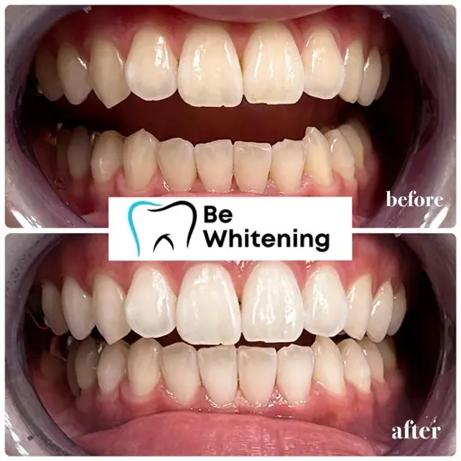 🥇人気No.1🥇まずはお試し【️ 15分照射×2回】セルフホワイトニング¥8800→¥3300(1日完結)