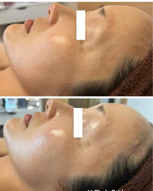 今月限定価格💐先着３名様♡【肌細胞を元気に✨水光肌トリートメント】スキンケア浸透率が上がり肌がかわる、土台作り