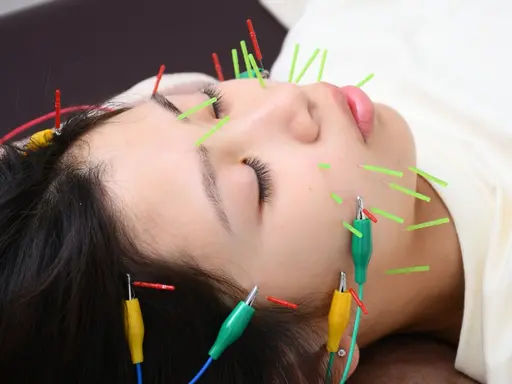 【美容鍼灸が初めての方におすすめ】★美容鍼+小顔矯正★ 初回¥5.500（ニキビ/肌質改善/たるみ）