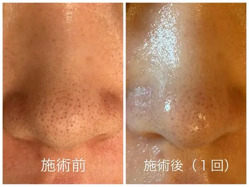 【3/4（水）特別価格】毛穴ごっそり洗浄フェイシャル🥚✨モニター価格