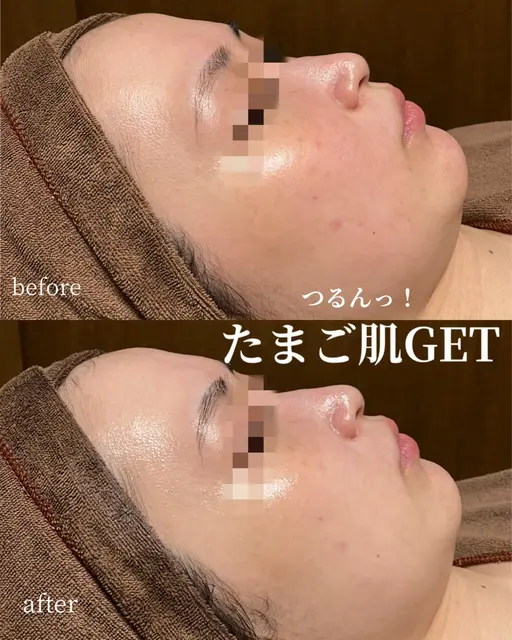 【1月限定✨】冬の乾燥集中ケア肌のリセットに 乳酸菌ピーリング