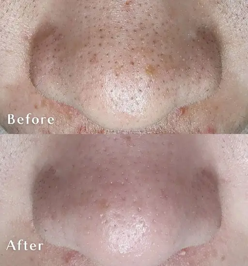 毛穴洗浄 90分 レディースメンズOK👌