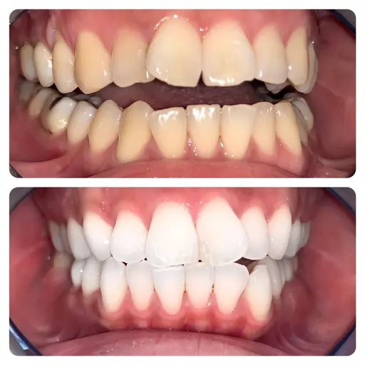 【人気No.1】Wプレミアムホワイトニング 4来店計160分照射 徹底的な白さへ✨