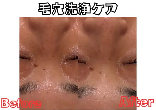 【5名限定！！】毛穴掃除付き！フェイシャルエステ♡