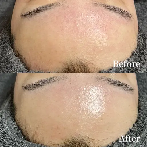 🍋【ニキビ毛穴シミに】REVIハーブピーリング《陶肌トリートメント》➕VCFリキッド 0.8ml